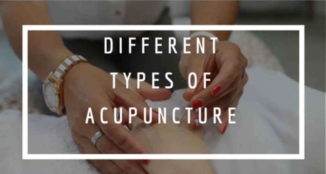 ACUPUNCTURE PICTURE
